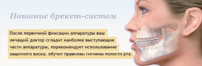 Ношение брекет-систем