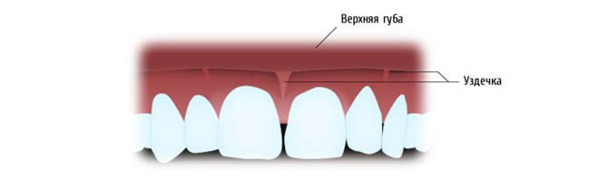 Вестибулопластика.jpg