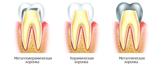 Зубные коронки