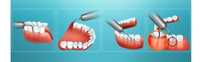 Глубокая поддесневая чистка (кюретаж пародонтальных карманов)